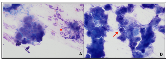 Figure 2. Impression smears of cutaneous lesions on front digits. 2A. A cluster of keratinocytes (left) and neutrophilic infiltrates (asterisk). 2B. Acantholytic keratinocytes (arrow) amongst poorly preserved squamous epithelial cells and debris. Wright’s stain, 60x. 