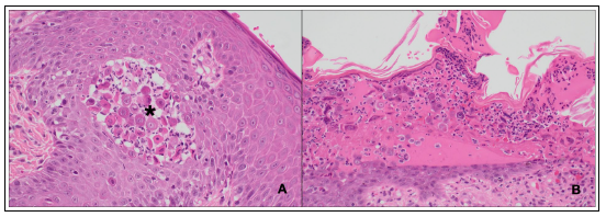 Figure 3. Histology of punch biopsies from cutaneous lesions. 3A. Intraepidermal pustule with acantholytic keratinocytes (asterisk) and neutrophils. H&E stain, 40X. 3B. Serous exudate with neutrophils, acantholytic keratinocytes and cellular debris. H&E stain, 20X. 