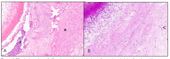Figure 2. Histologic sections of affected guttural pouch. A. Area of necrosis underlying fungal mat (*), with colonies of bacteria (X). (H&E stain, 20X).  B. Area of necrosis overlaid by PAS-staining fungal mat with histologic features suggestive of Aspergillus spp.  There is some invasion of the underlying necrotic tissue by fungi (<). (PAS stain, 40x).