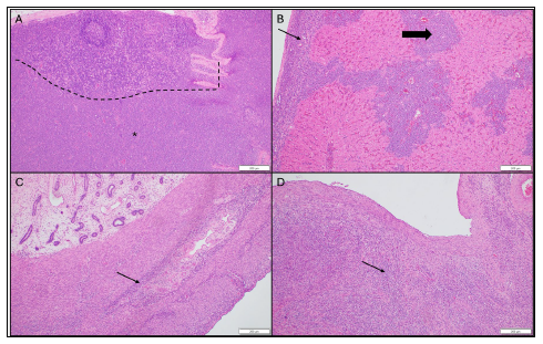 Figure 2. Histologic sections of tissues infiltrated by neoplastic lymphocytes. H&E stain.  2A. Lymph node. Neoplastic lymphocytes efface the normal architecture (asterisk). 2B. Liver. Subcapsular (thin arrow) and periportal (thick arrow) neoplastic lymphocytes. 2C. Uterus. Perivascular neoplastic lymphocytes (thin arrow). 2D. Ovary. Stromal neoplastic lymphocytes (thin arrow).