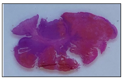 Figure 1. Perineum. An exophytic, pedunculated mass arises from the dermis at junction of haired and unhaired skin. Subgross, H&E stain.