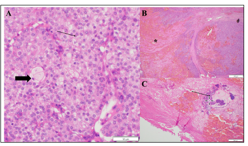 Figure 2. Dermis, perineum. H&E stain. 2A. Most of the tumour cells exhibit basal cell differentiation (thin arrow), but some of the cells exhibit sebocyte-type differentiation (thick arrow). 40X.                     2B. Approximately 60% of the mass is necrotic and includes scattered neutrophils and abundant hemorrhage (asterisk). 10X. 2C. The surface of the mass is ulcerated and coated with a serocellular      crust with scattered degenerate neutrophils, and numerous colonies of basophilic coccoid bacteria       (thin arrow). 10X. 