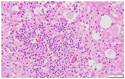 Figure 1. Goat brainstem. Necrosis of the parenchyma with microabscesses composed of neutrophils and macrophages. H&E stain, 40x.
