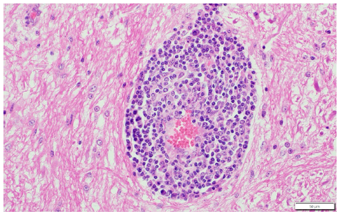 Figure 2. Bovine brain. Perivascular cuffing of cerebral blood vessels with macrophages, lymphocytes and fewer neutrophils. H&E stain, 40x.