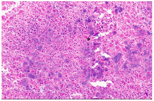 Figure 3. Goat fetal liver. Focus of necrosis with neutrophils and dense colonies of coccobacilli (*) amongst the necrotic debris. H&E stain, 40x.