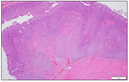 Figure 1. Porcine ileal Peyer’s patch. Submucosal Peyer’s patches are indistinct due to  loss of cellularity. H&E stain.