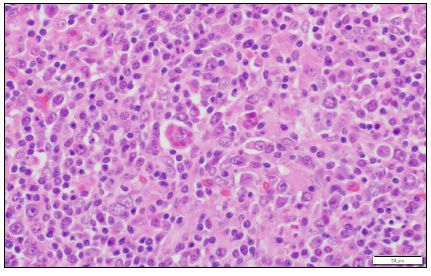 Figure 2. Porcine ileal Peyer’s patch. Macrophages with intracytoplasmic botryoid viral  inclusion bodies (arrows). H&E stain.