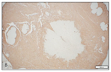 Figure 1. Canine, spinal cord. 1A. The meninges are markedly expanded by an infiltrate of neoplastic round cells which surround and invade the spinal cord and adjacent nerve roots. H&E stain.1B. Neoplastic cells demonstrate strong reactivity (brown colour) for the histiocytic immunohistochemical marker Iba-1. 