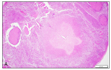 Figure 1. Canine, spinal cord. 1A. The meninges are markedly expanded by an infiltrate of neoplastic round cells which surround and invade the spinal cord and adjacent nerve roots. H&E stain.1B. Neoplastic cells demonstrate strong reactivity (brown colour) for the histiocytic immunohistochemical marker Iba-1. 