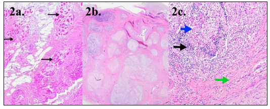 Figure 2. Histologic lesions of polyneuritis equi. H&E stain. 2a. Marked skeletal muscle atrophy of the SCV with small, individualized skeletal myocytes surrounded by fibrous and adipose tissues. 4x. 2b. The epineurium of sacral spinal nerve bundles is markedly expanded and fused with adjacent nerve bundles. Sacral spinal nerves are variably effaced by a cellular infiltrate. 4x. 2c. Marked infiltration and replacement of degenerate nervous tissue by lymphocytes (black arrow) and macrophages (blue arrow). Streams of expansile epineurial fibrous tissue are also present (green arrow). 20x.