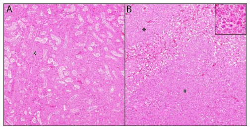 Figure 1. Myeloproliferative disease in a Silkie chicken characterized by diffuse infiltration (*) of kidney (A) and liver (B) by immature myeloid cells (inset). H&E stain.