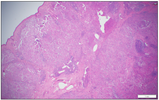  Low magnification histologic view of the mammary tissue showing extensive effacement by       pyogranulomatous inflammation. The skin surface is at the upper left. H&E stain.