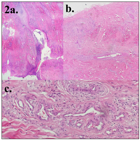 Figure 2. Histologic lesions compatible with chronic progressive lymphedema. H&E stain.  a. Hyperkeratosis with thick crusts and formation of deep necrotic crevasses between skin folds 10x. B. Marked deep dermal fibrosis and proliferation of nested vascular plexi with surrounding fibrosis. 20x. C. proliferative vascular nest with surrounding fibrosis and mild inflammation. 40x.