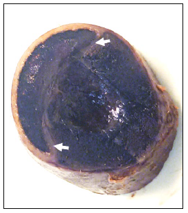 Figure 1. Cross section of the gallbladder at the time of trimming. The compressed gallbladder lumen is forming a crescent on the left side of the image, and the hematoma forms the majority of the tissue on the right. The white arrows indicate the fibrous septa separating these structures. 