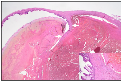 Figure 2. Histologic cross section of the gallbladder with the same orientation as figure 1. The hematoma is on the right with abundant blood in the lumen. The gallbladder forms a compressed, crescent structure on the left, with an incomplete fibrous septa between them (indicated by the arrows). The inset shows the gallbladder mucosa on the left and the unlined fibrous wall of the hematoma on the right. H&E 