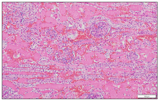 Figure 2. Kidney. Acute tubular necrosis with interstitial hemorrhage. H&E, 20X.
