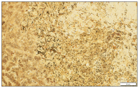 Figure 4. Liver, Steiner silver stain, 40X. Numerous argyrophilic filamentous rod-shaped bacteria at the junction of viable and necrotic tissue. 