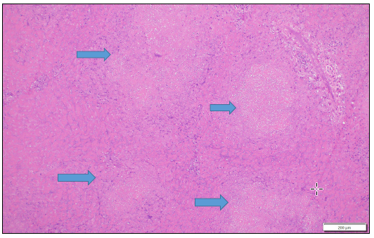 Figure 3. Liver, H&E stain, 10X. Multiple pale foci of acute hepatocellular necrosis (arrows). 