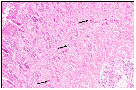 Figure 1. Ulcerative and necrotizing ventriculus with intranuclear inclusion bodies in a laying hen. There is ulceration and loss of the superficial mucosa, and remaining epithelial cells contain large basophilic intranuclear inclusions (arrows). H&E stain, 20x.