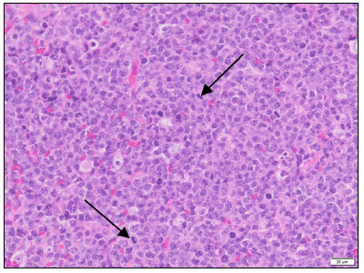 Figure 1. The neoplasm is composed of sheets of round cells with numerous mitotic  figures (arrows). H&E stain.