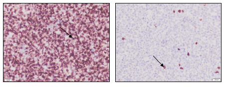 Figure 2. Most neoplastic round cells have positive nuclear PAX5 staining (arrow, left image).  Only a few scattered infiltrating non-neoplastic T lymphocytes have positive cytoplasmic CD3  staining (arrow, right image).